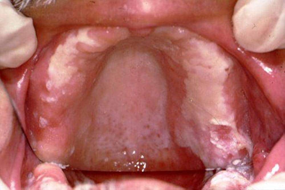 Stomatitis Caused by <i>Candida</i>