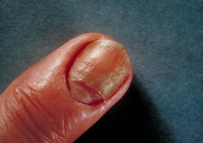 Nail Infection (Candidiasis)