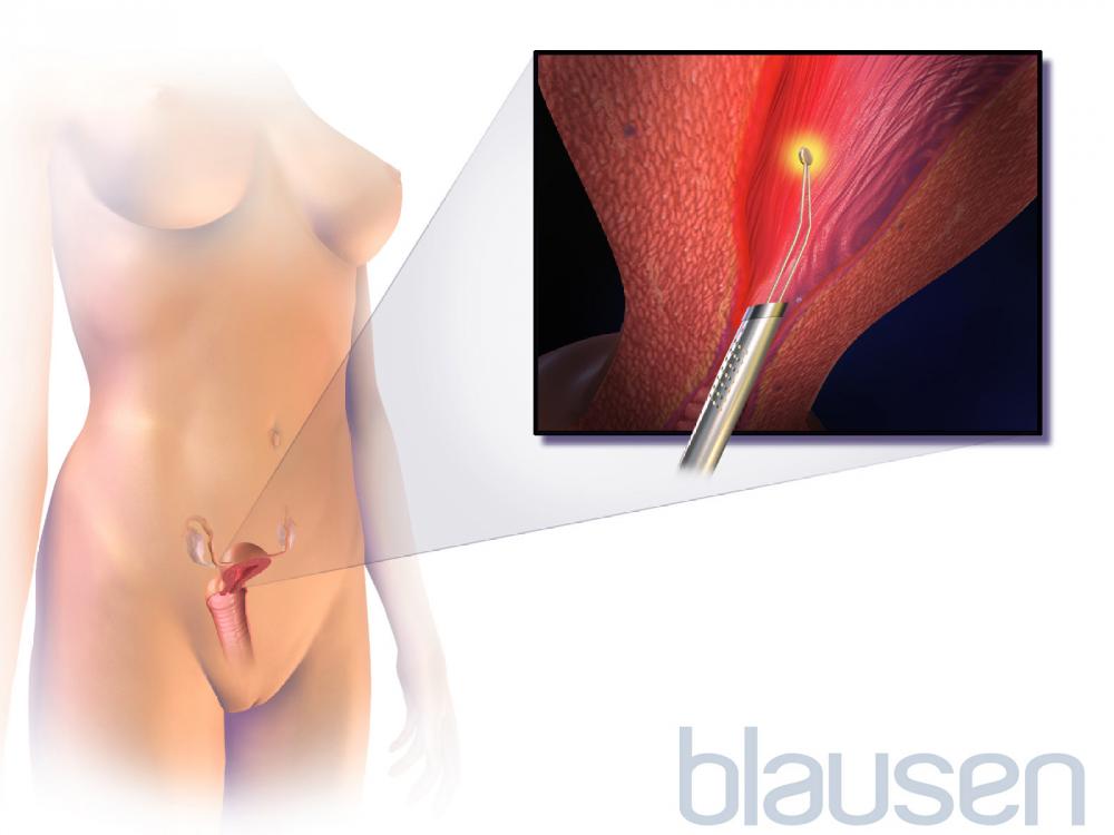 Endometrial Ablation