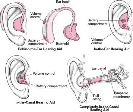 Hearing Aids: Amplifying the Sound