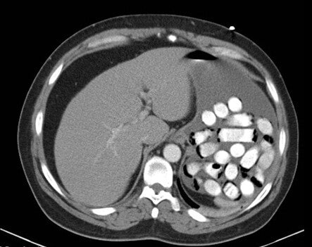 Foreign Body in the Stomach (Computed Tomography Scan)