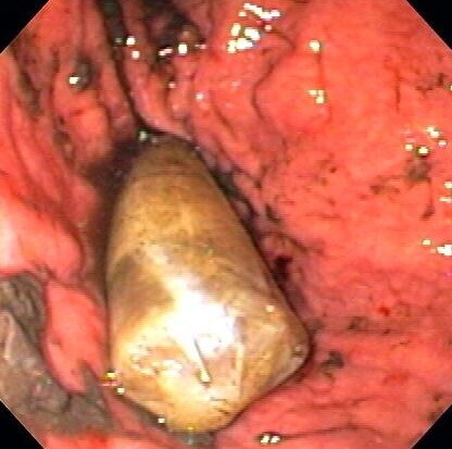 Foreign Body in the Stomach (Endoscopy)