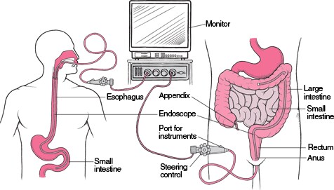 Viewing the Digestive Tract With an Endoscope