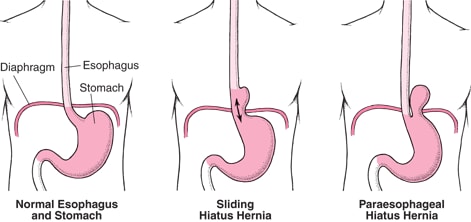 Understanding Hiatus Hernia