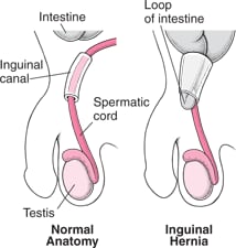 What Is an Inguinal Hernia?