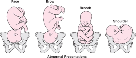 Position and Presentation of the Fetus