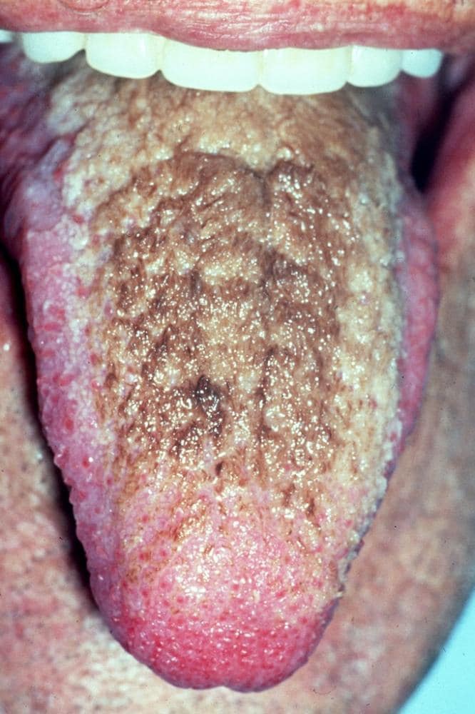 Tongue Discoloration and Other Changes - Mouth and Dental Disorders