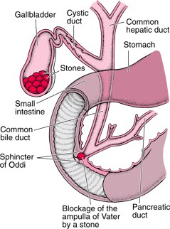 What Are Gallstones?