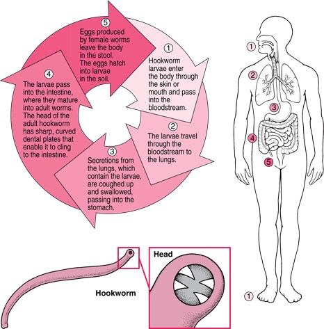 effects of hookworms in humans effects of hookworms in humans