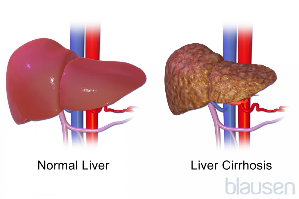 Cirrhosis