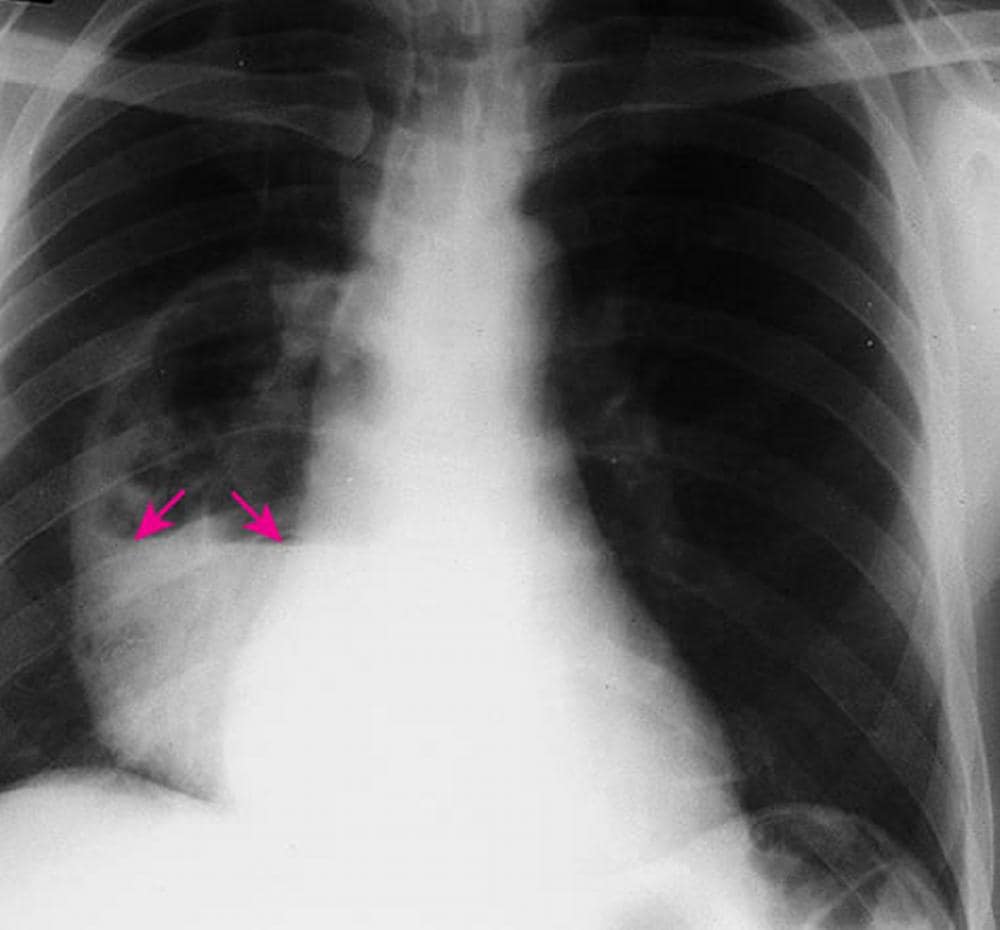 Lung Abscess