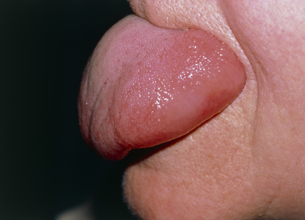 Angioedema of the Tongue