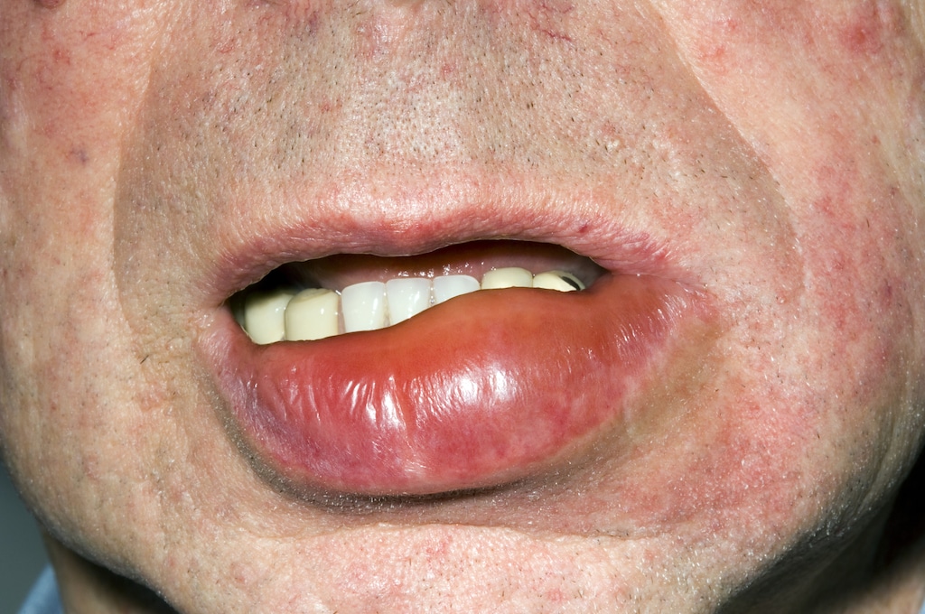Angioedema of the Lips