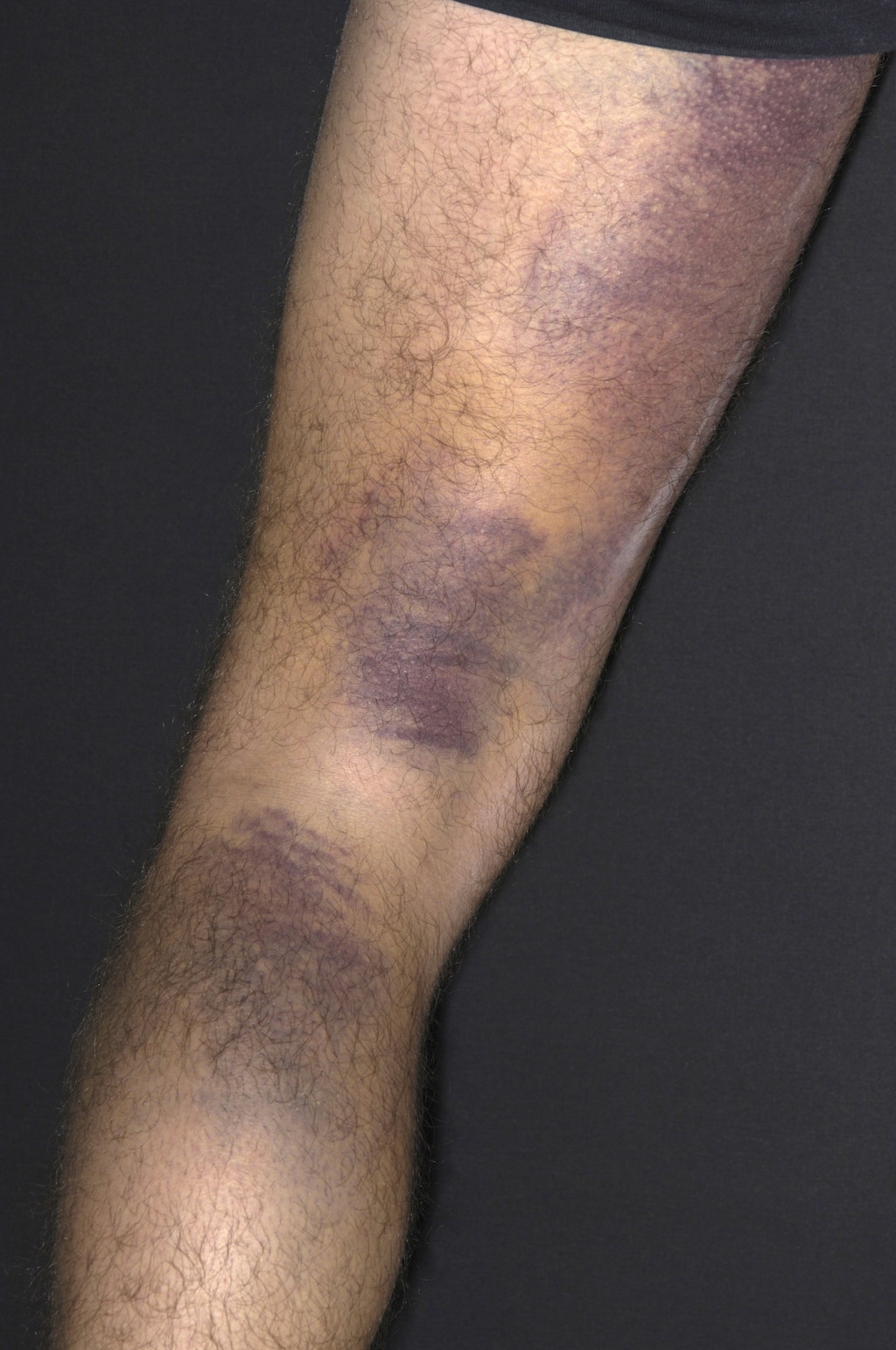Ecchymoses (Bruises)