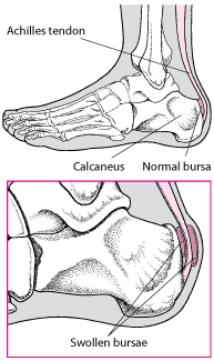 Bursitis in the Heel