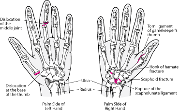 Common Hand Injuries