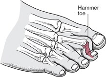 What Is Hammer Toe?