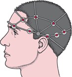 Brain Activity During a Seizure