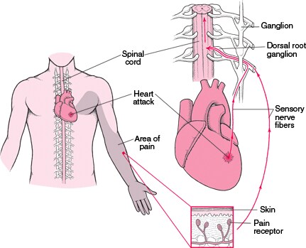 What Is Referred Pain?