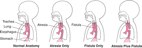 Atresia and Fistula: Defects in the Esophagus