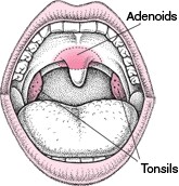 Locating the Tonsils and Adenoids