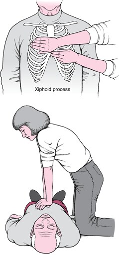 Doing Chest Compressions in an Adult