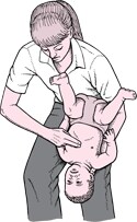 Clearing a Blocked Airway in an Infant