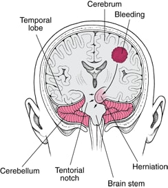 Brain Herniation: The Brain Under Pressure