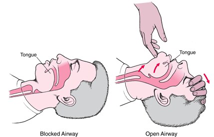 Opening an Airway in an Adult or Child