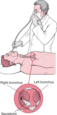 Understanding Flexible Bronchoscopy