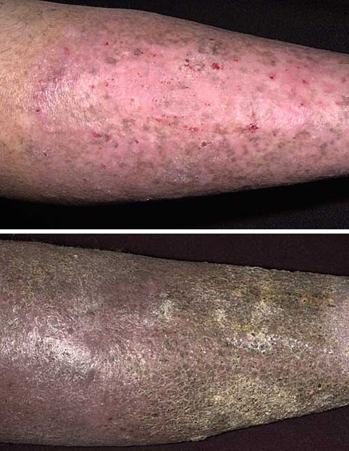 Chronic Venous Insufficiency (Skin Changes)