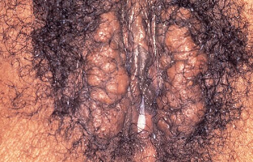 Vulvar Epidermal Inclusion Cysts
