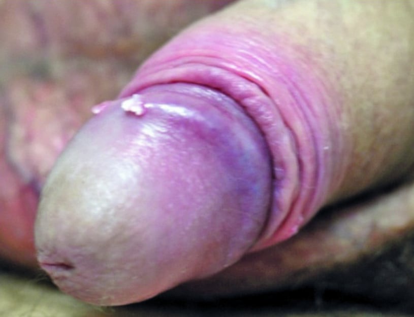 Genital Warts (Glans)