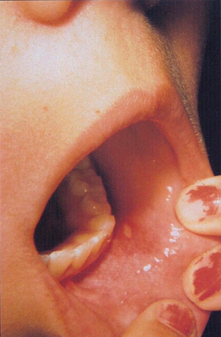 Hand-Foot-and-Mouth Disease (Oral Lesions)