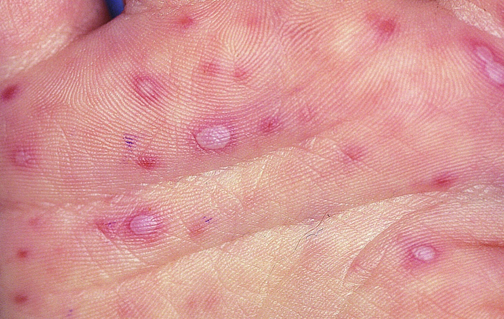 Hand-Foot-and-Mouth Disease (Hand Lesions)