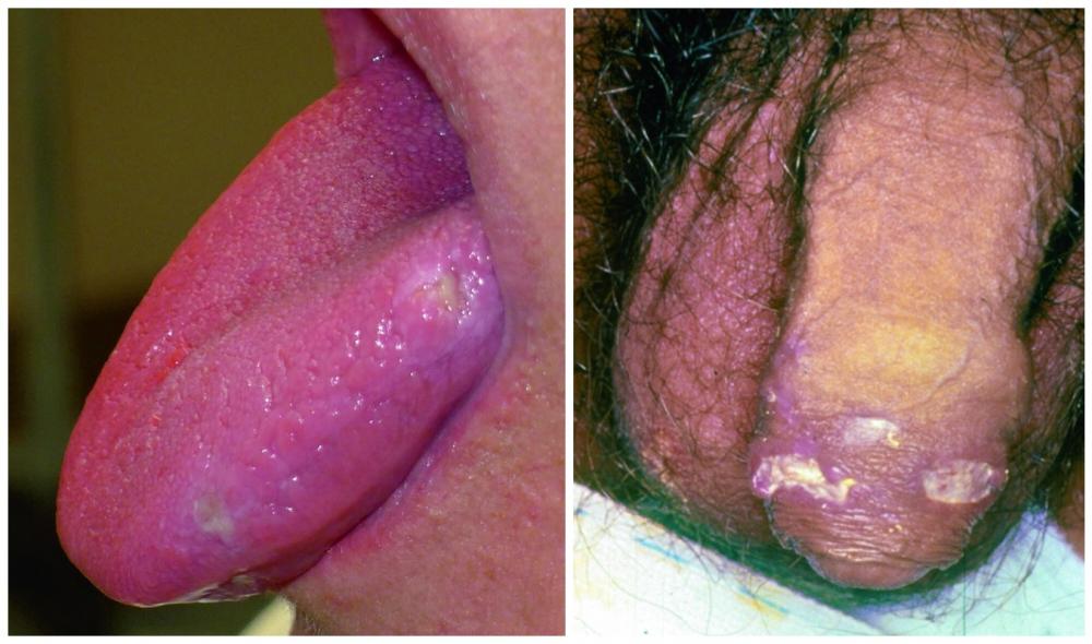 Oral and Genital Lesions in Behçet Disease