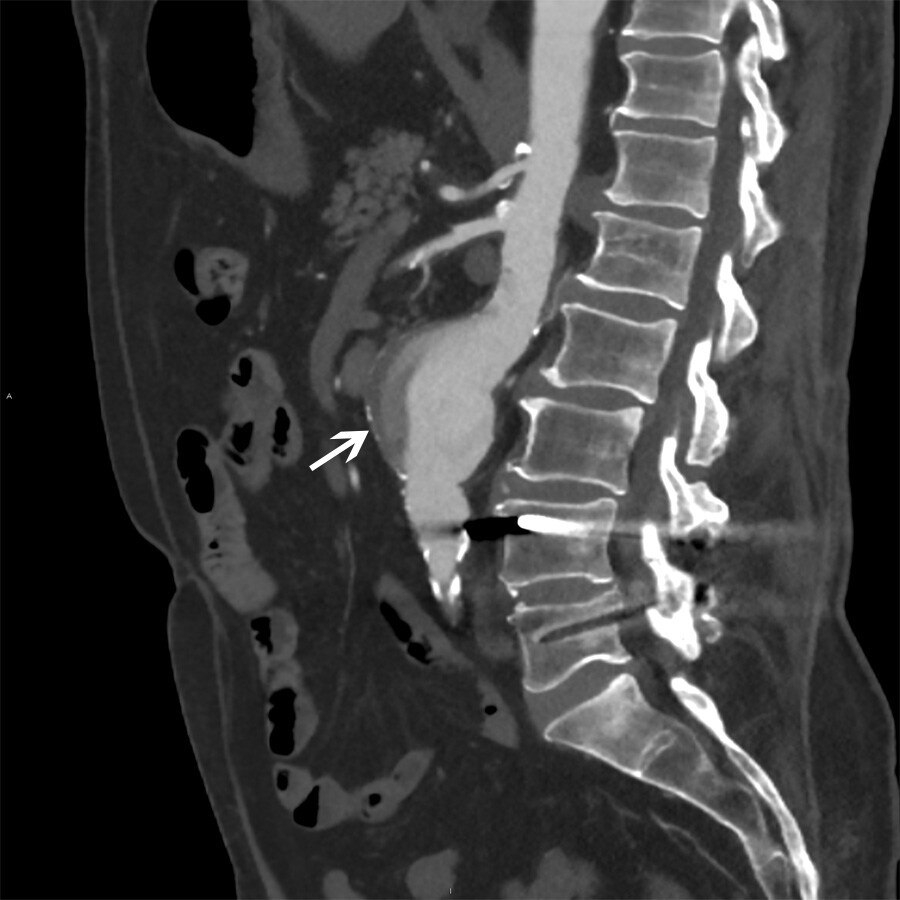Abdominal Aortic Aneurysm (CT Scan)