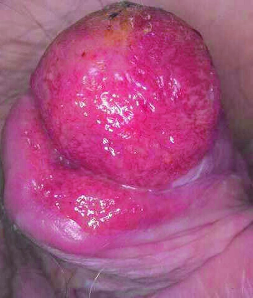 Erythroplasia of Queyrat With Penile Carcinoma
