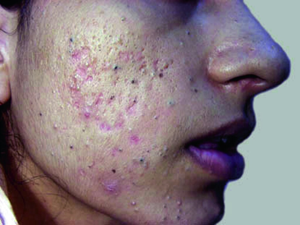 Acne With Large Comedones