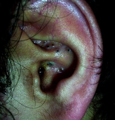 Acne With Auricular Comedones