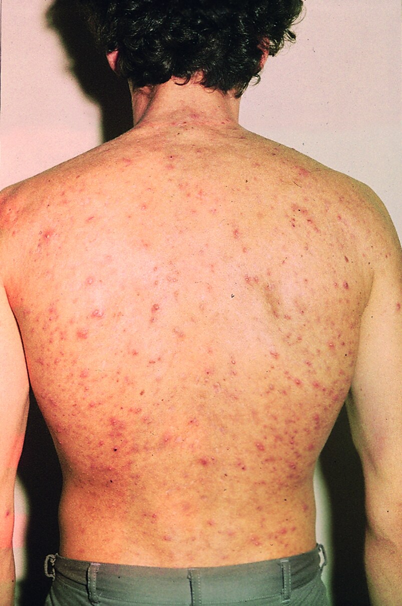 Acne Affecting the Body