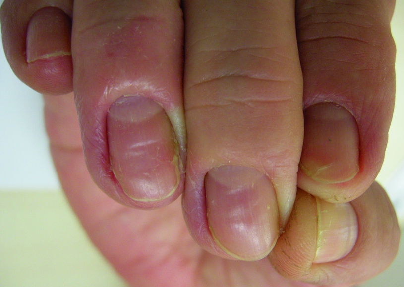 Chronic Paronychia With Swollen Proximal Nail Fold and Loss of Cuticle