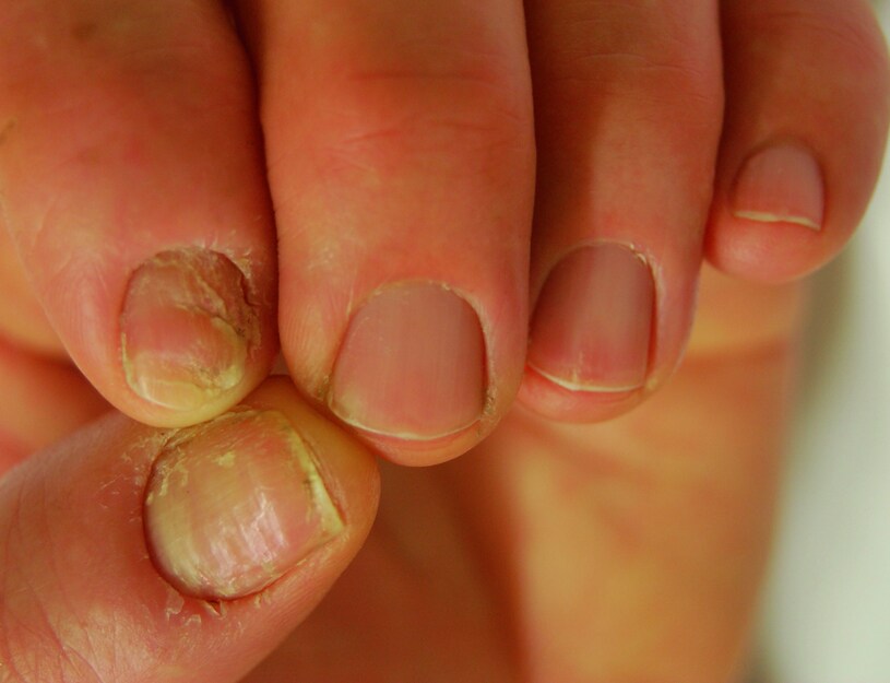 Chronic Paronychia With Nail Plate Swelling, Absence of the Cuticle, and Abnormalities of the Nail Plate