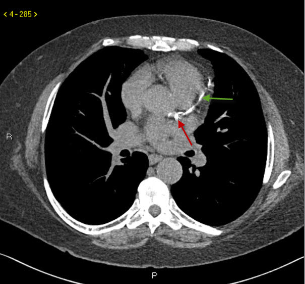 Non-Contrast CT Showing Coronary Artery Calcification