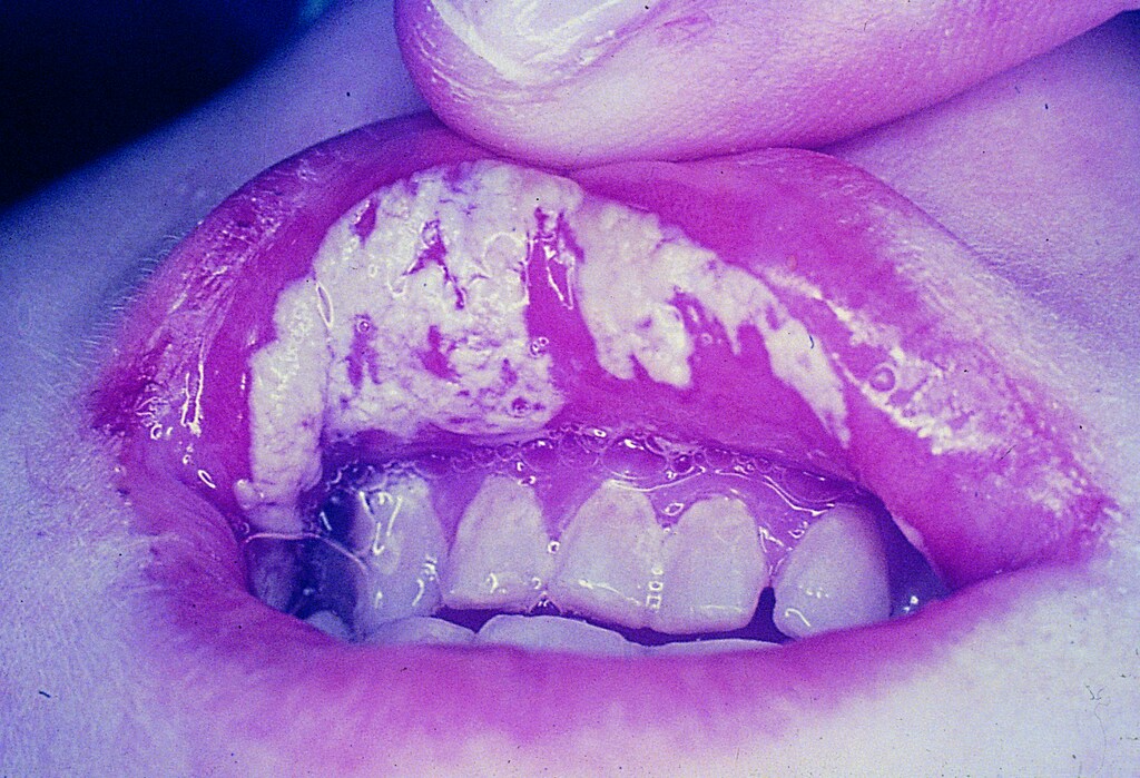 Oral Candidiasis (Labial Mucosa)