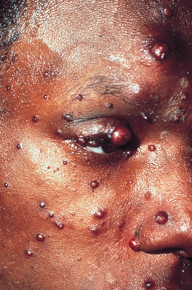 Disseminated Bartonellosis in HIV Infection