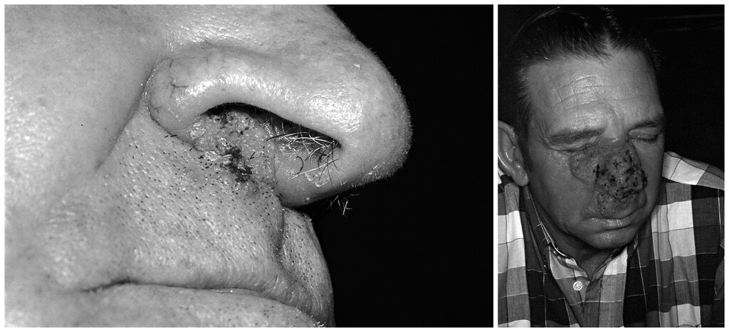 Extrapulmonary Blastomycosis (Mild and Severe Skin Lesions)