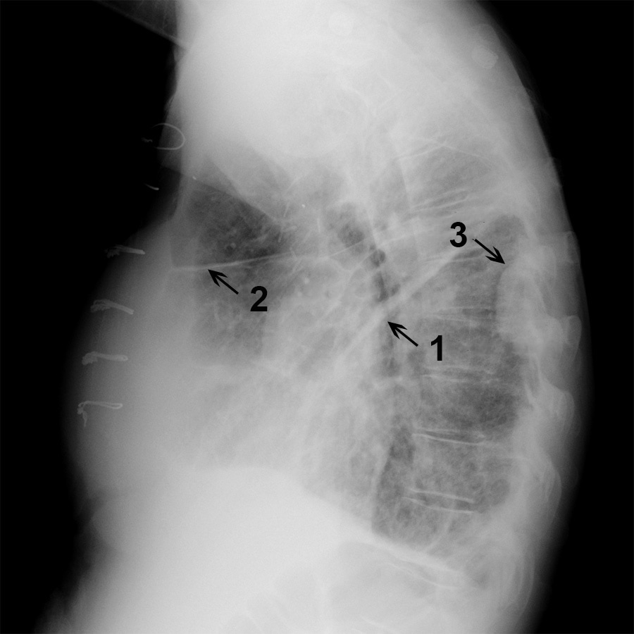 Chest X-Ray of a Patient with Fluid in Minor and Major Fissures
