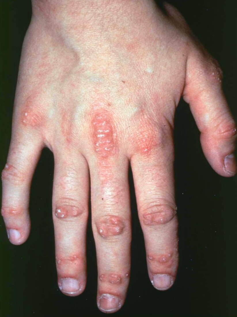 Dermatomyositis (Hand Findings)