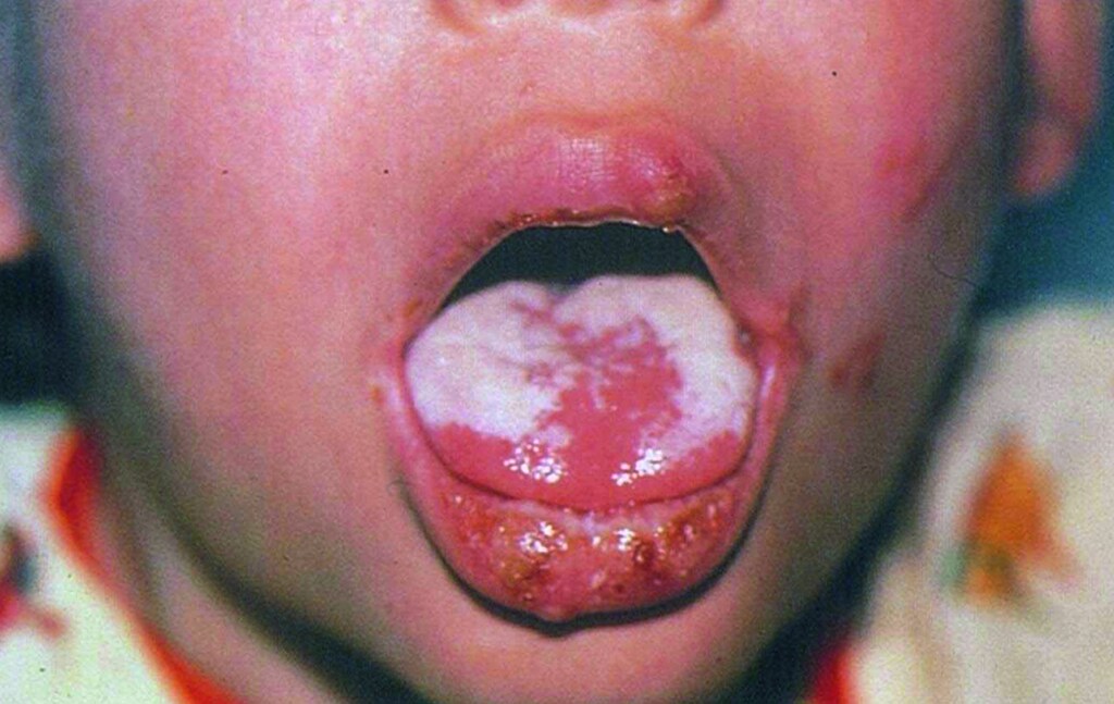 Oral Candidiasis (Tongue)